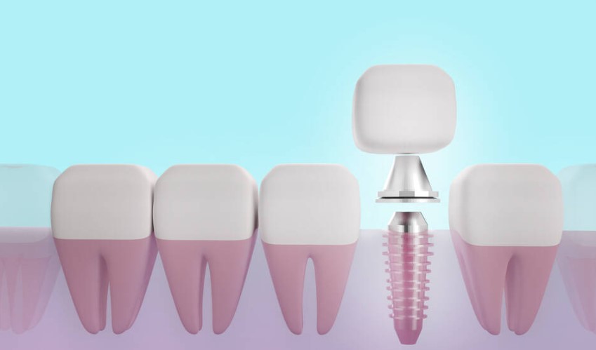 all on 4 dental implant