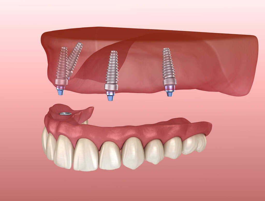 How long do all on 4 dental implants in Mindaire last? all on 4 dental implants in Mindaire