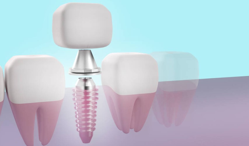all on 4 dental implants